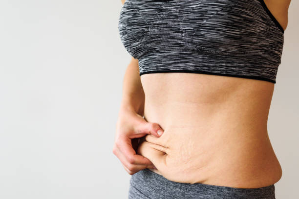 woman belly after dieting
